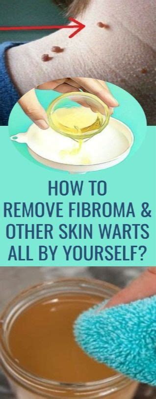 Remedies Home How To Remove Fibroma And Other Skin Warts All By