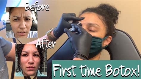 Getting Botox For The First Time For Glabella Lines Eleven 11 Lines