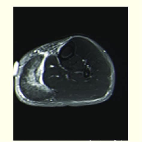 Axial Proton Density Fat Saturated Image Through The Left Calf Showing Download Scientific
