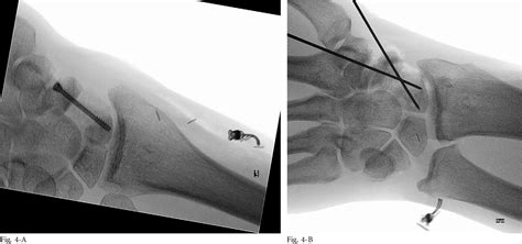 Figure 4 From Free Vascularized Medial Femoral Condyle Bone Graft After