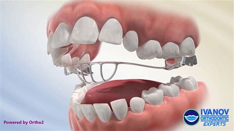 Tongue Crib Tongue Thrust Dental Habits Orthodontics