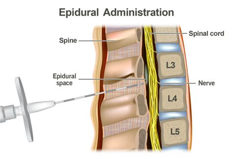 Think About Taking An Epidural During Work