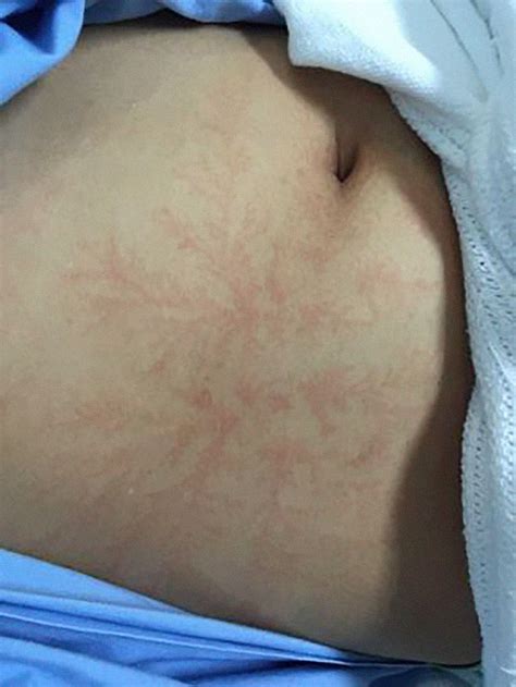 Lightning scarred earth, part 2 by andrew hall in lightning scarred earth, part 1, shiprock was presented as an example of a pinnacle created by lightning. Lichtenberg Figure: The scars Left On Lightning Strike Survivors (Photos) - Health - Nigeria