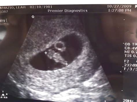 michael angelo my junebug first ultrasound 7 weeks pregnant