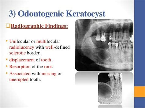 Odontogenic Keratocyst Surgical Nursing Radiology Imaging Human