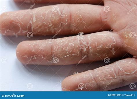 Peeling Skin On Hand And Fingers Desquamation Stock Image Image Of