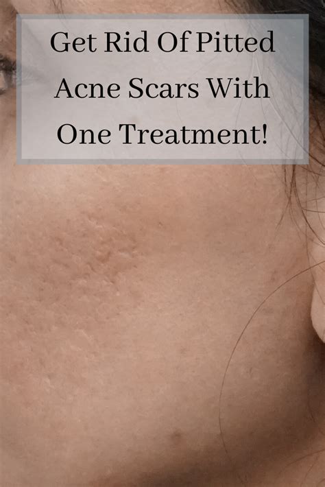 How Do I Get Rid Of Pitted Acne Scars Wererabbits
