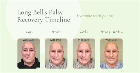 Long Bells Palsy Recovery Timeline With Photos • Crystal Touch Bell