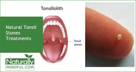 How To Get Rid Of Tonsil Stones Video Howtoremvo
