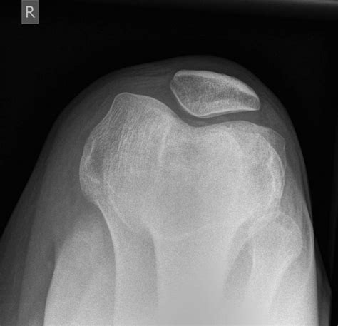 Emrad Radiologic Approach To The Traumatic Knee
