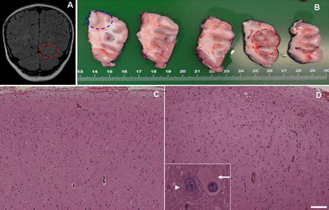 Imaging And Pathologic Features Of Focal Cortical Dysplasia Type Iib