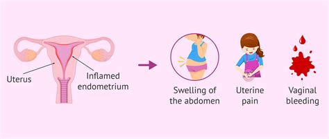 Symptoms Of Endometritis