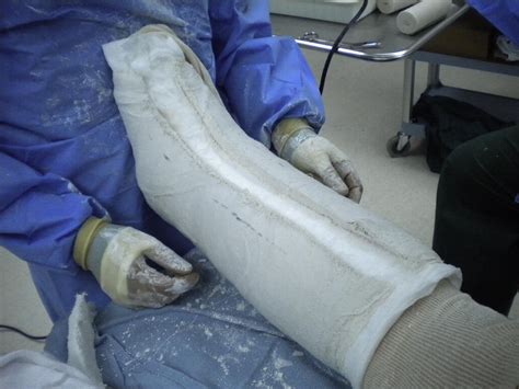 Univalve Split Plaster Cast For Postoperative Immobilization In Foot