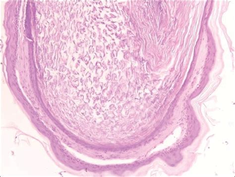 Epidermal Inclusion Cyst Histology