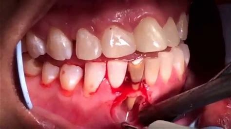 Endodontic Surgery Apicoectomyandretrofillingand Bone Graft Youtube