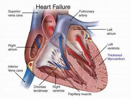Complete information about congestive heart failure, including signs and symptoms; Medicine for health care: Congestive Heart Failure ...