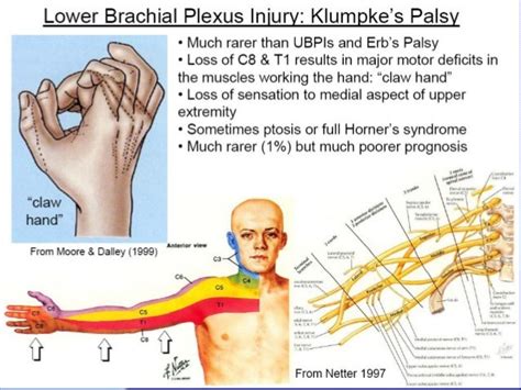 Brachial Plexus Injuries By Krr