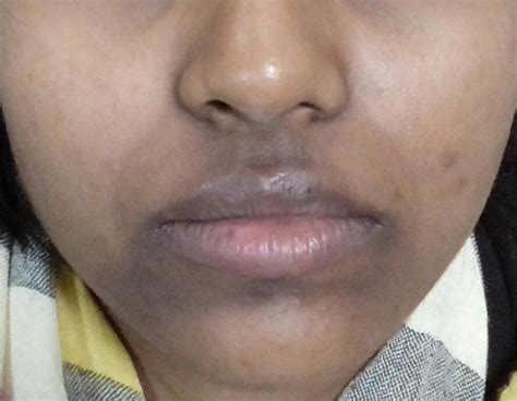 Hyperpigmentation Around The Mouth Causes And Treatments Justinboey