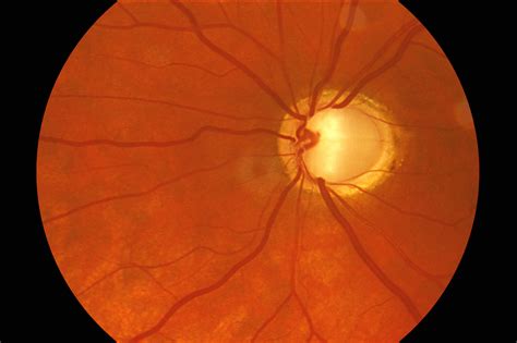 Optometry Atlas Optic Nerve Conditions Viewpoint