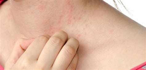Is Psoriasis Contagious What You Should Know
