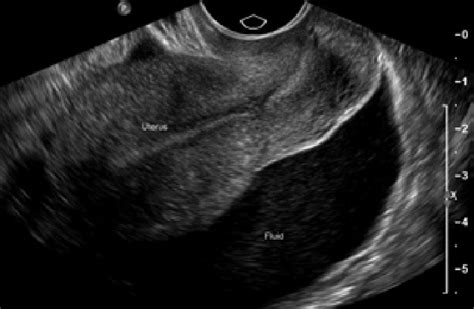 The Presence Of Free Pelvic Fluid In The Cul De Sac Is Highly