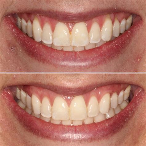 Esthetic Periodontics and Gum Grafting - Meridian Periodontics & Dental 