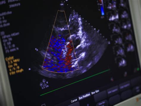 Echocardiograms Are Available At Md First Primary And Urgent Care
