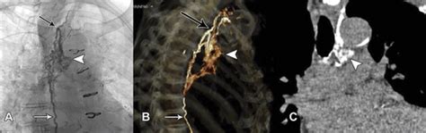 Intranodal Ct Lymphangiography With Water Soluble Iodinated Contrast