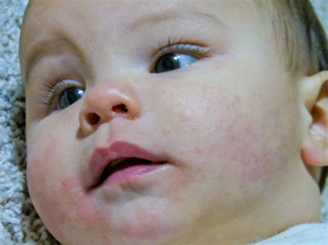 Baby Eczema Colin Had Some Eczema Popping Up On His Face