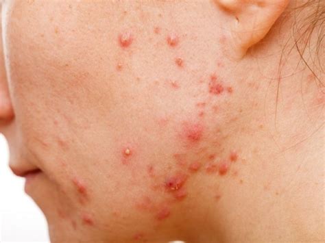 3 Stages Of Acne You Need To Know Inside Humans