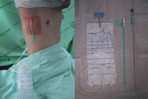 Pigtail Catheters Vs Large Bore Chest Tubes For Management Of Secondary