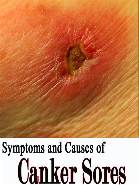 Canker Sores Are More Of Sores Or Blisters That Is Known To Appear In