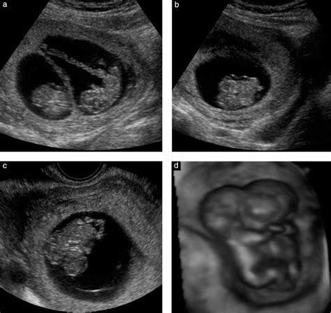 Conjoined Twins In A Triplet Pregnancy Early Prenatal Diagnosis With