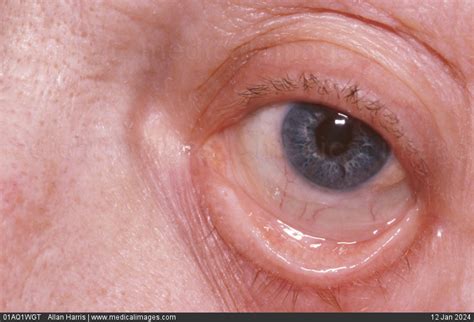 Stock Image Metabolic Anemia Extreme Pallor Of The Lower Inner Eyelid