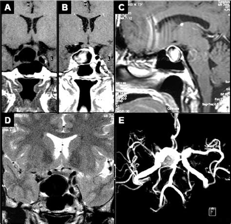 Mri And Angioresonance Of A Years Old Woman With Internal Carotid