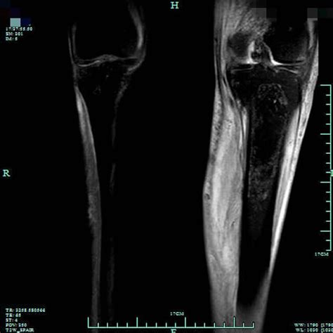 Bilateral Knee Joint Mri Examinations Show Joint Effusion In The Left