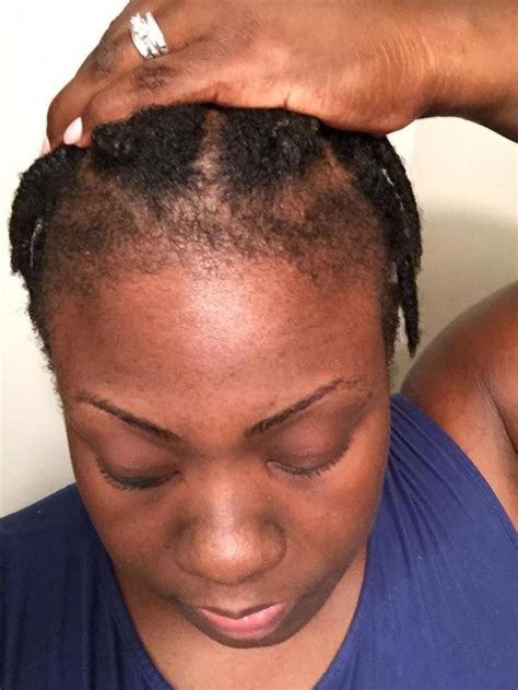 Adaptable Recognized Black Women Hair Loss Yours For Asking In 2020