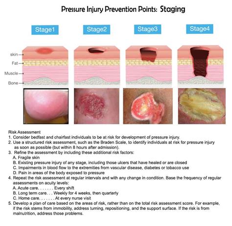 How To Treat Stage 2 Pressure Ulcer