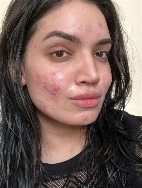 Kadeeja Khan In Girl With Acne Bare Beauty Acne Skin