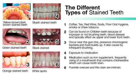 11 Step By Step Guide On How To Whiten Your Teeth Instantly Beamglo Stained Teeth Whitening
