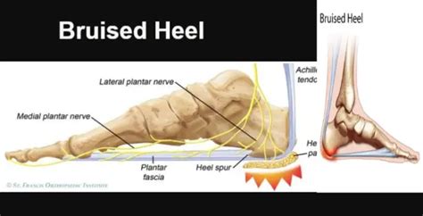 Bruised Heels Causes And Home Remedies Body Pain Tips