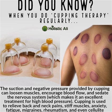 Cuppingtherapy And All Its Healthbenefits 👆🏽🙌🏽 Thebest Getcupped Feelbetter Cupping