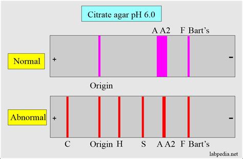 Hemoglobin Part 2 Hemoglobin Electrophoresis Hb Electrophoresis