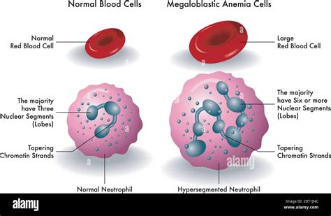 Medical Illustration Shows The Difference Between Normal Blood Cells