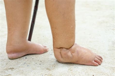 Premium Photo Feet Of People With Diabetes Dull And Swollen Due To