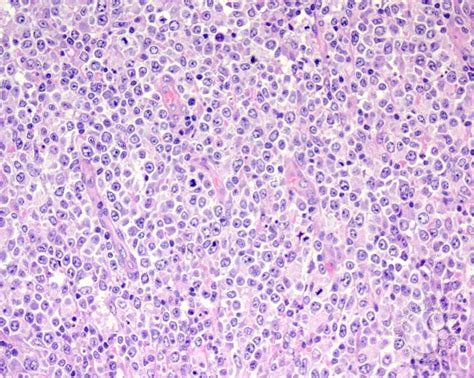 Diffuse Large B Cell Lymphoma Anaplastic Variant 2