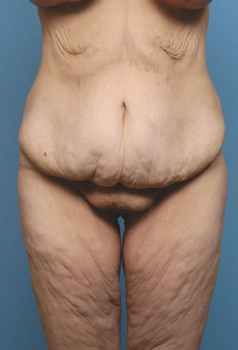 Bariatric Plastic Surgery Body Contouring After Large Weight Loss