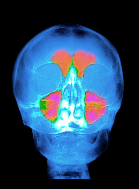 Coloured X Ray Of A Persons Head And Sinuses Photograph By Alfred
