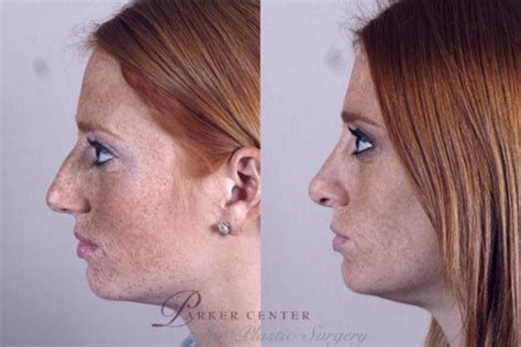 Rhinoplasty Before And After Pictures Case 142 Paramus Nj Parker