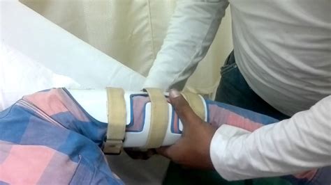 Splint For Fracture Of Humerus Youtube